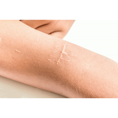 Эффективное лечение шрамов и рубцов